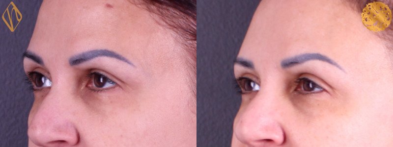 Brow Lift 1 Combined Image