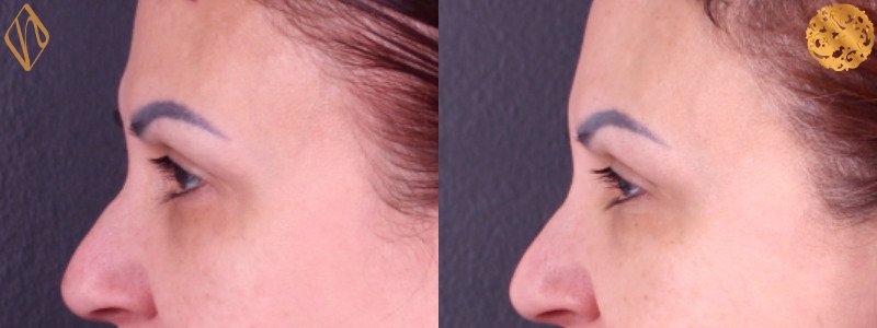 Brow Lift 1 Combined Image