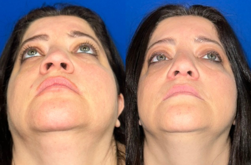 Ethnic Rhinoplasty 1 Combined Image