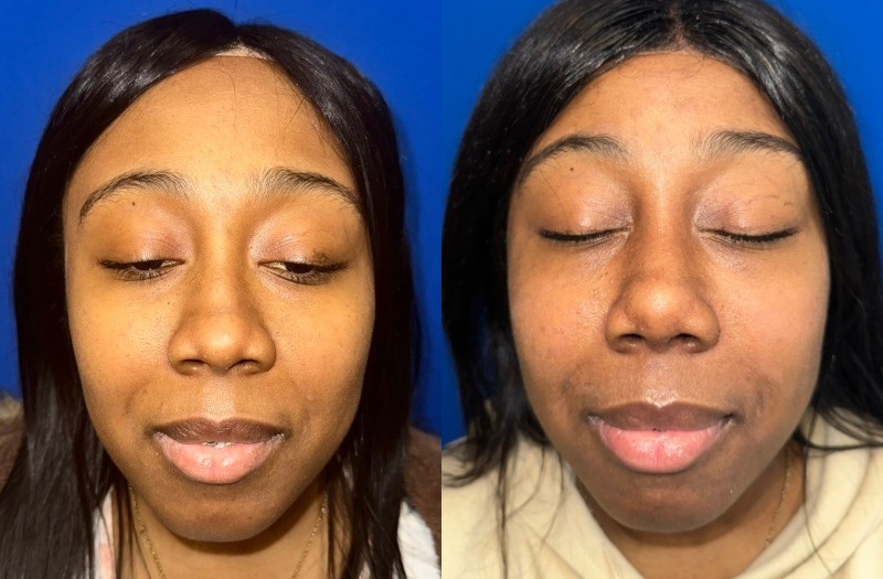 Ethnic Rhinoplasty 3 Combined Image