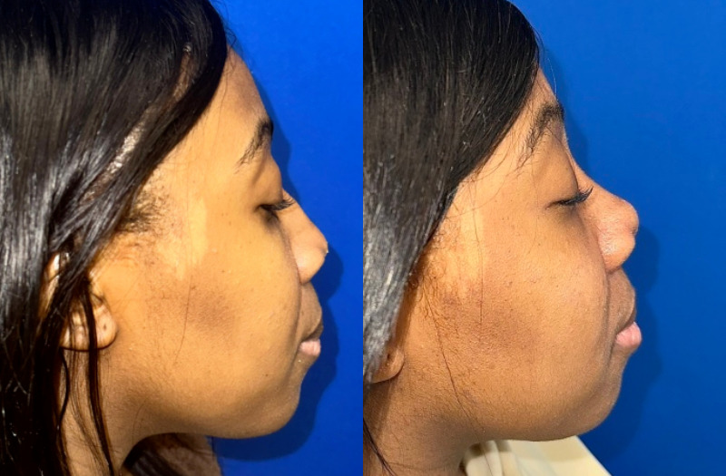 Ethnic Rhinoplasty 3 Combined Image