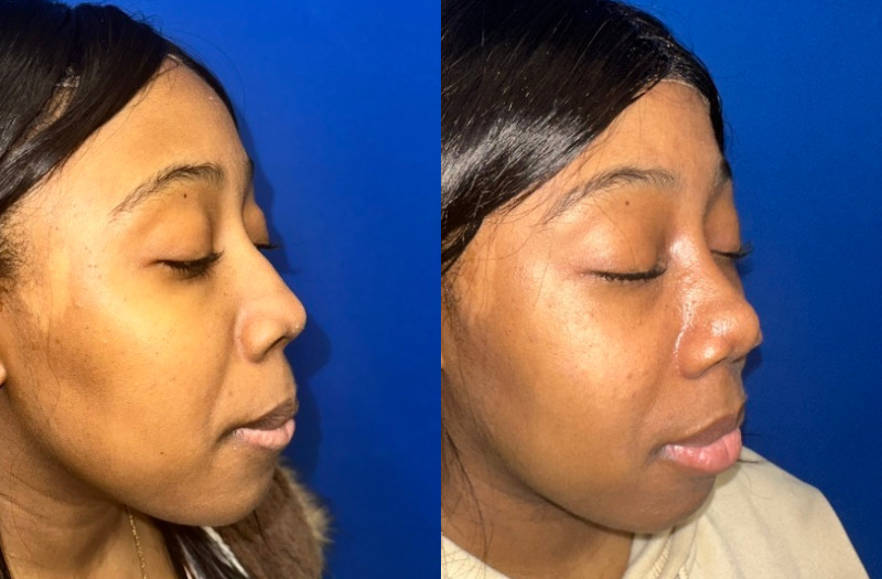 Ethnic Rhinoplasty 3 Combined Image