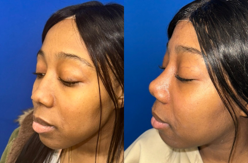 Ethnic Rhinoplasty 3 Combined Image