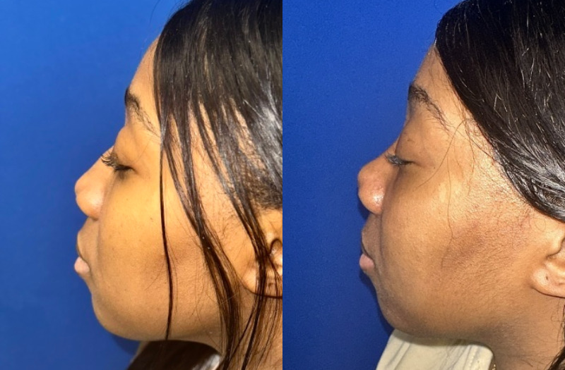 Ethnic Rhinoplasty 3 Combined Image