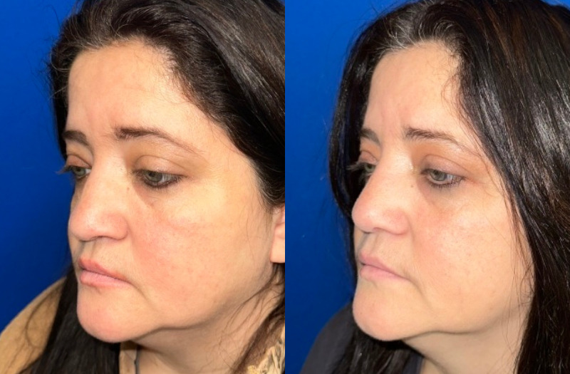 Ethnic Rhinoplasty 1 Combined Image