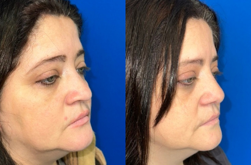 Ethnic Rhinoplasty 1 Combined Image