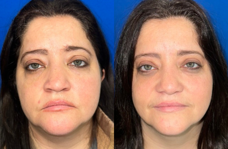 Ethnic Rhinoplasty 1 Combined Image