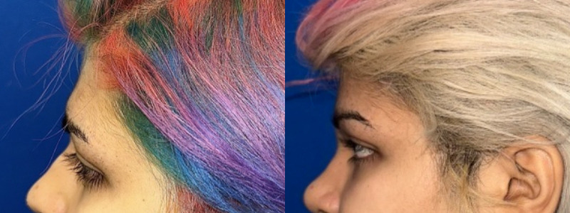 Forehead Contouring 1 Combined Image