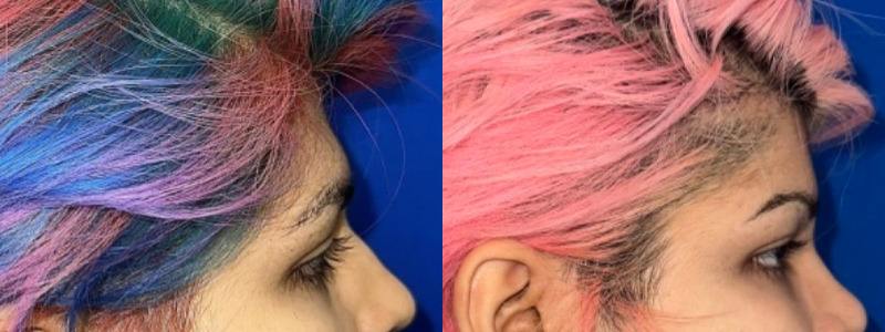 Forehead Contouring 1 Combined Image