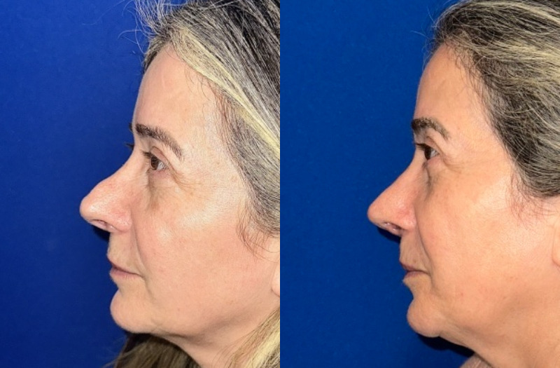 Revision Rhinoplasty 1 Combined Image