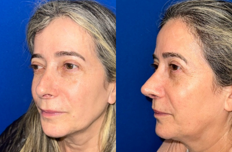 Revision Rhinoplasty 1 Combined Image