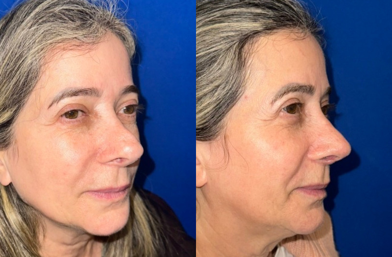 Revision Rhinoplasty 1 Combined Image