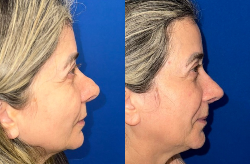 Revision Rhinoplasty 1 Combined Image