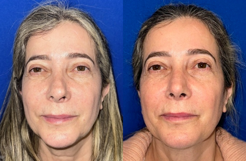 Revision Rhinoplasty 1 Combined Image