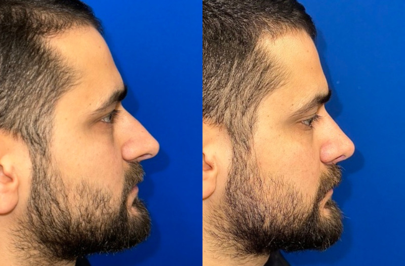 Rhinoplasty 2 Combined Image
