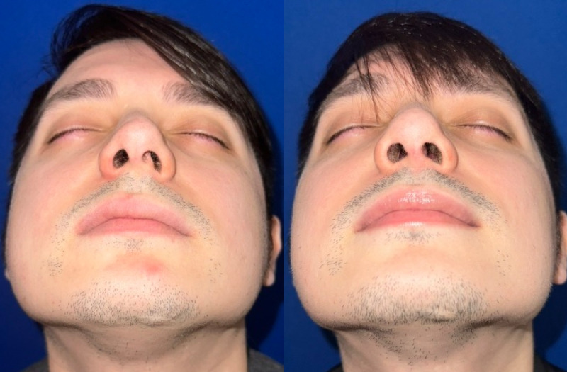 Rhinoplasty 3 Combined Image
