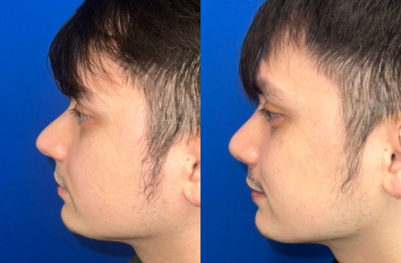 Rhinoplasty 3 Combined Image