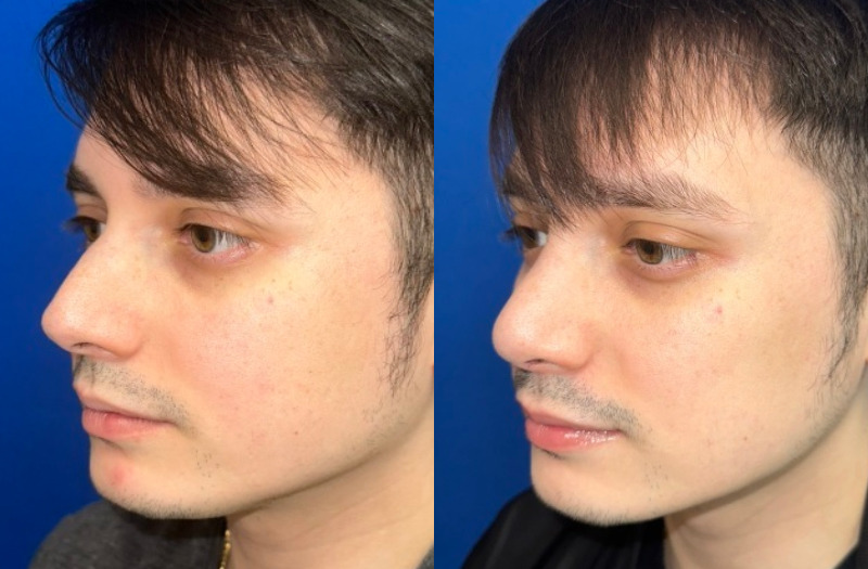 Rhinoplasty 3 Combined Image