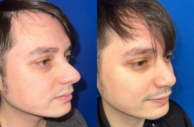 Rhinoplasty 3 Combined Image