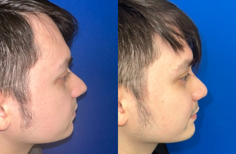 Rhinoplasty 3 Combined Image