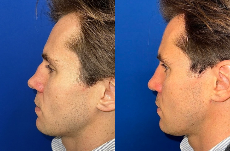 Rhinoplasty 1 Combined Image