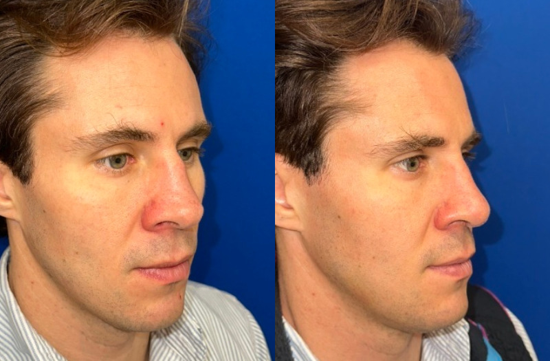 Rhinoplasty 1 Combined Image