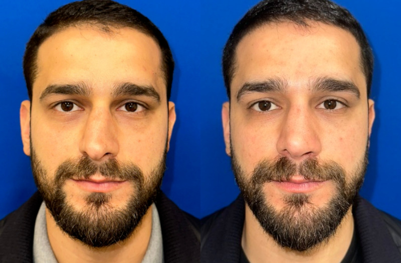 Rhinoplasty 2 Combined Image