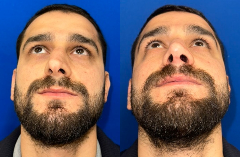 Rhinoplasty 2 Combined Image