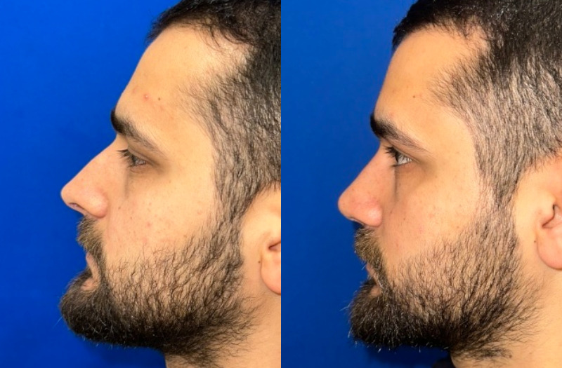 Rhinoplasty 2 Combined Image