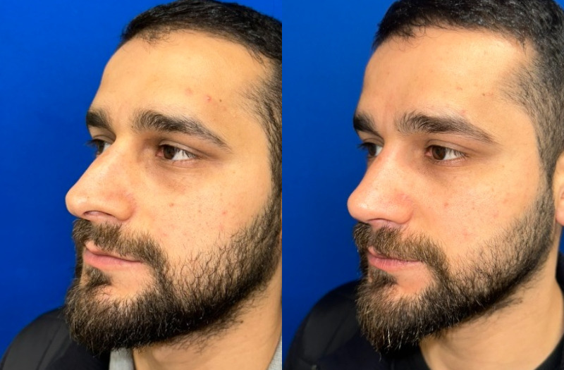 Rhinoplasty 2 Combined Image