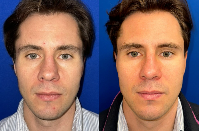 Rhinoplasty 1 Combined Image