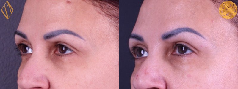 Botox 1 Combined Image