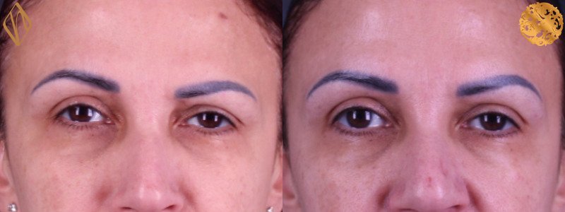 Botox 1 Combined Image