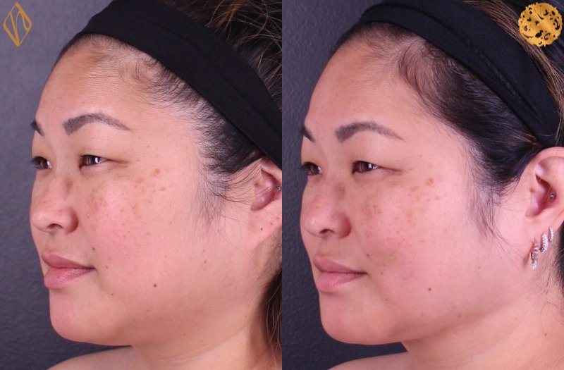 Buccal Fat Reduction 1 Combined Image