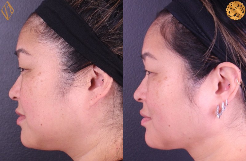 Buccal Fat Reduction 1 Combined Image