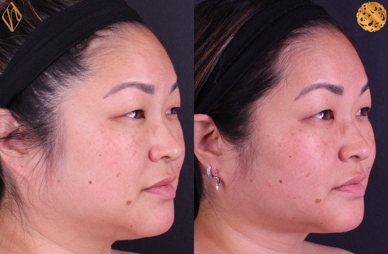 Buccal Fat Reduction 1 Combined Image