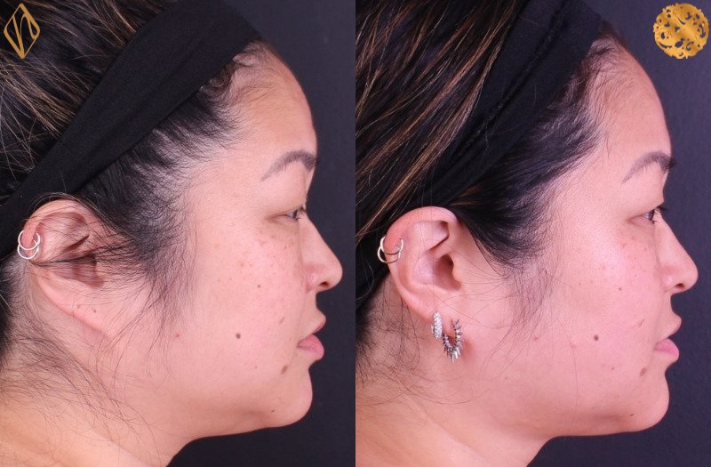 Buccal Fat Reduction 1 Combined Image
