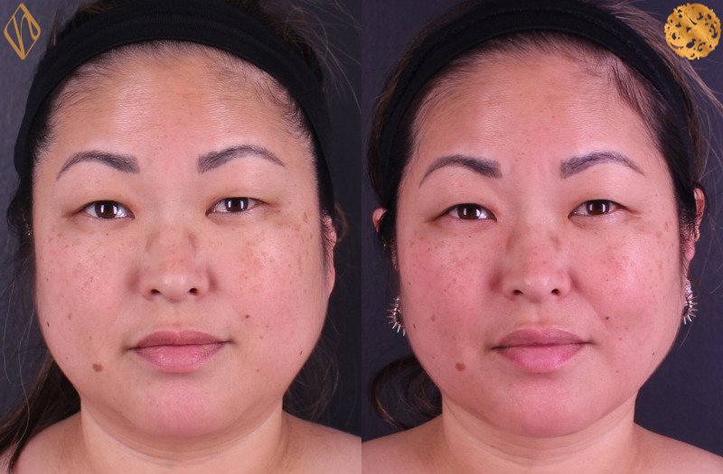 Buccal Fat Reduction 1 Combined Image