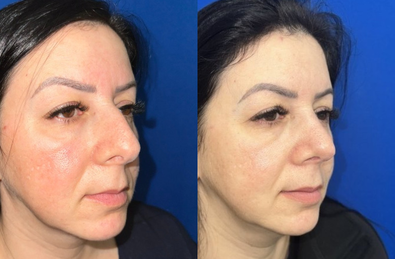 Ethnic Rhinoplasty 2 Combined Image