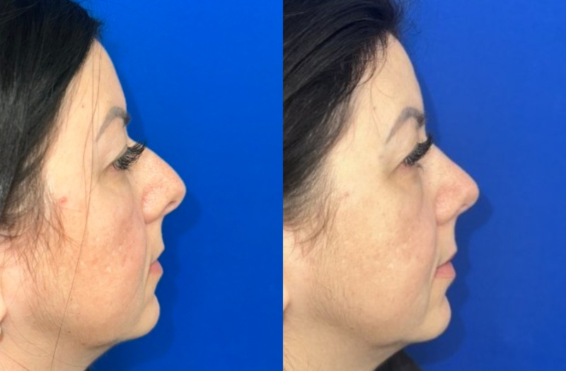 Ethnic Rhinoplasty 2 Combined Image
