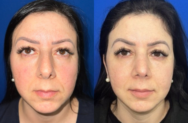 Ethnic Rhinoplasty 2 Combined Image