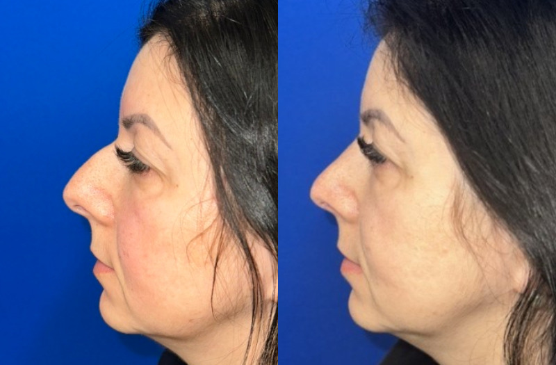 Ethnic Rhinoplasty 2 Combined Image