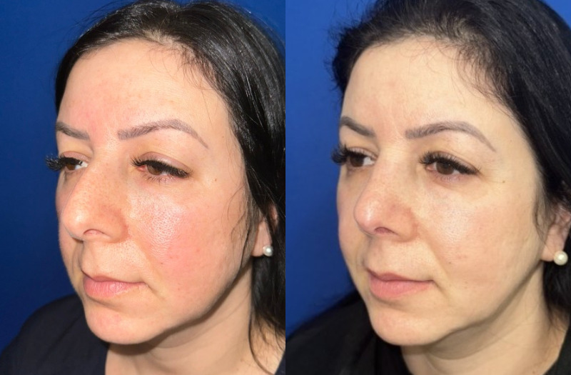Ethnic Rhinoplasty 2 Combined Image