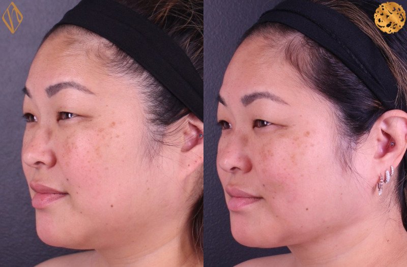 FaceTite 1 Combined Image