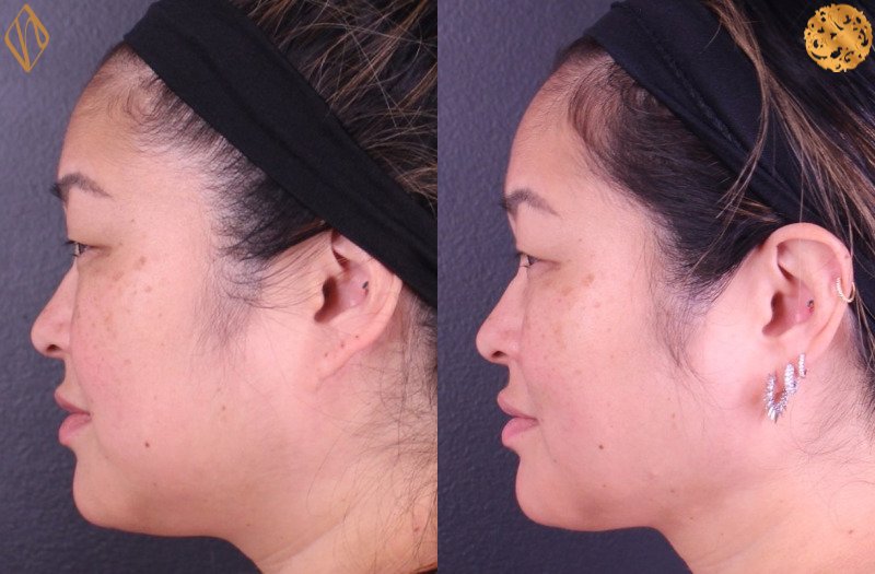 FaceTite 1 Combined Image