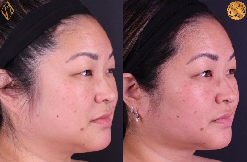 FaceTite 1 Combined Image