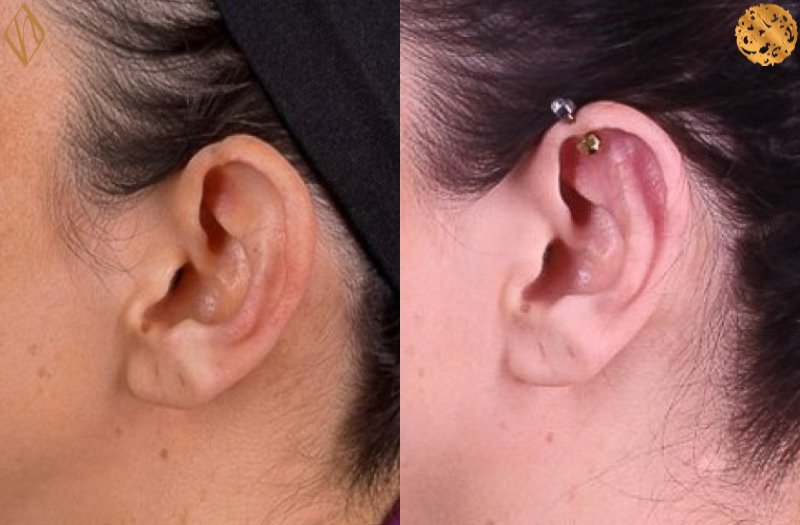 Otoplasty 1 Combined Image