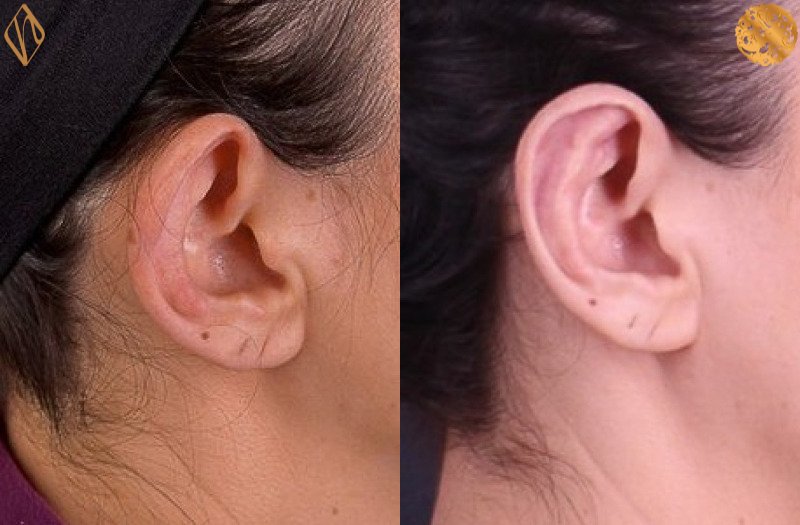 Otoplasty 1 Combined Image