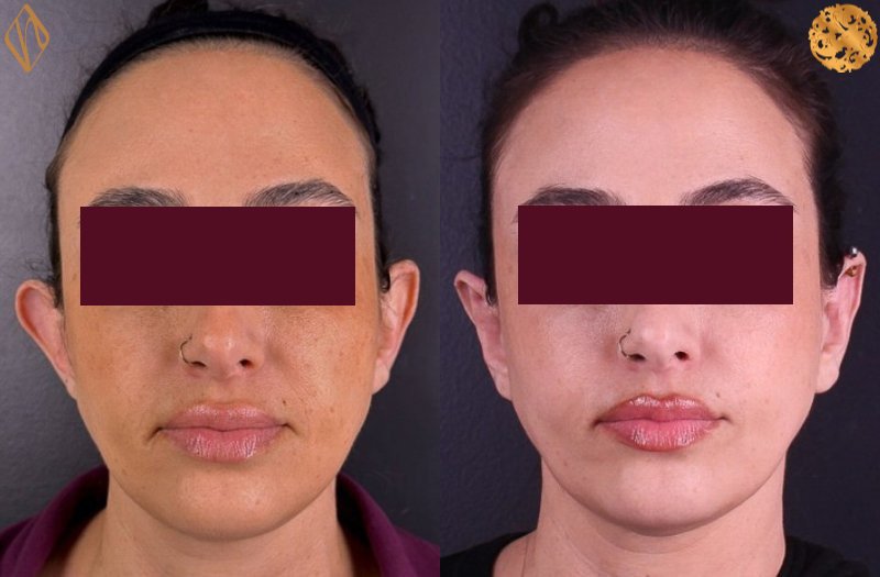 Otoplasty 1 Combined Image