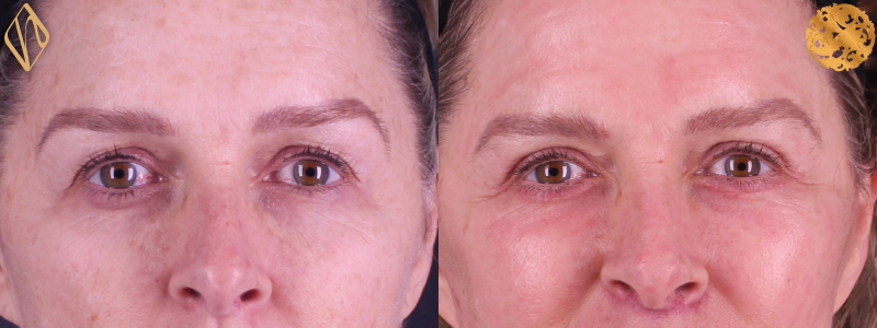 Blepharoplasty 2 Combined Image